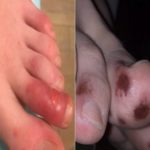 Lesões na ponta dos dedos pode ser uma manifestação de covid-19