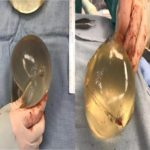 Mulher leva tiro e sobrevive graças a implante de silicone nos seios