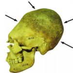 Crânios deformados do século 5 ajudam a entender migrações europeias