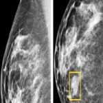 Inteligência artificial detecta câncer de mama antes de médicos