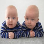 Número de Nascimentos de Gêmeos Aumenta Drasticamente
